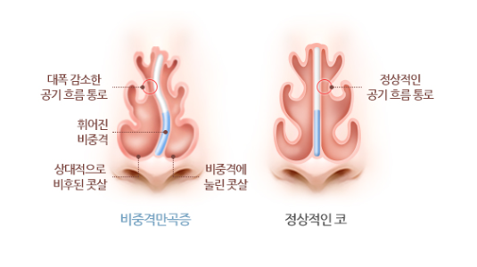 강남이비인후과 코수술, 지앤지이비인후과를 선택한 이유