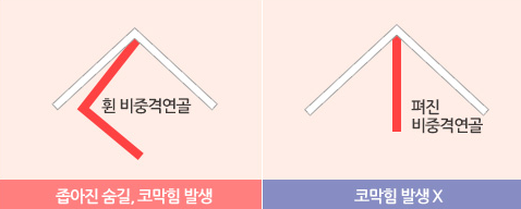 비중격만곡증 재발 반복되는 코막힘 재수술 시점 사진 3