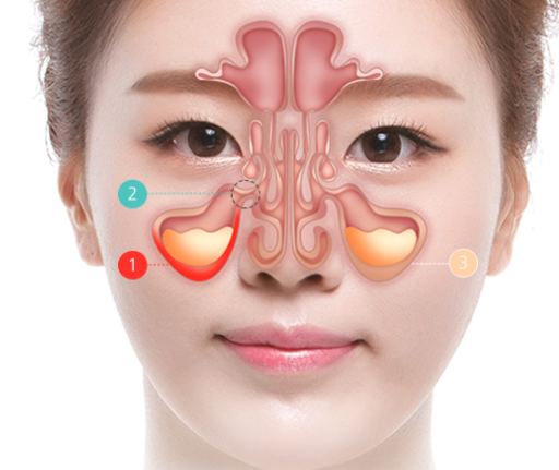 비중격만곡증 재발 반복되는 코막힘 재수술 시점