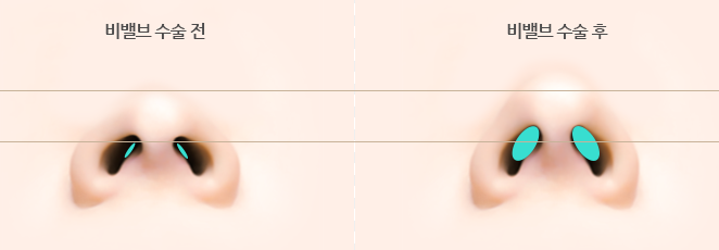 한쪽 코만 막혀요, 또 생기는 코막힘 원인은? 사진 4