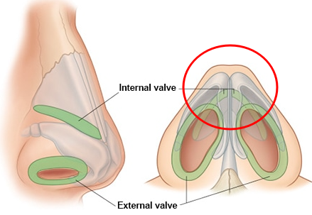 잘때 코막힘 누우면 심해질 때 수술 따져봐야 할까 사진 4