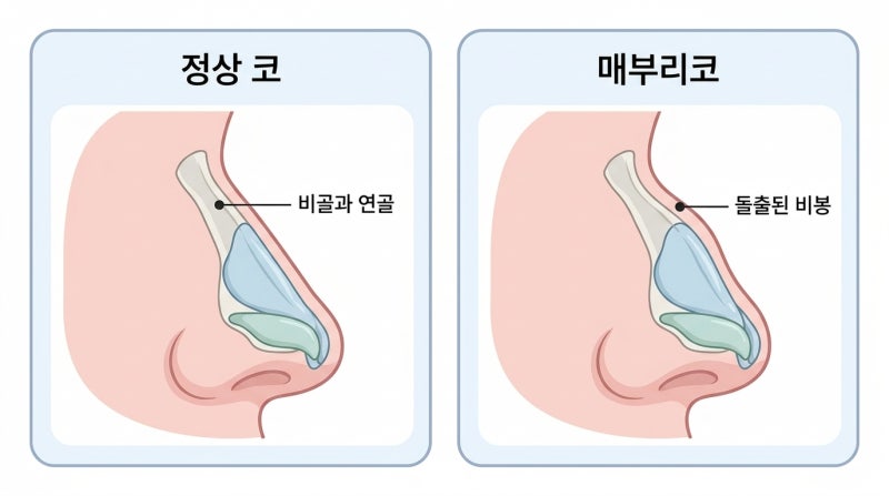 매부리코 성형수술 필러와 절골 사이 선택 기준