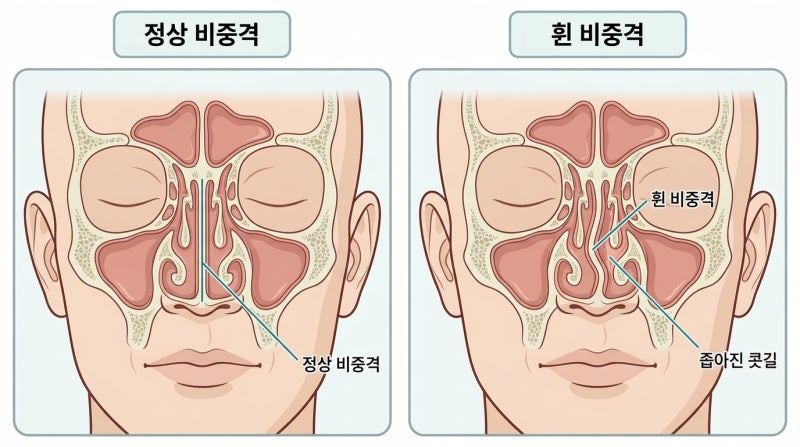 코뼈 휨 비중격까지 틀어졌다면 보험 적용될까
